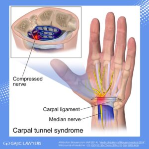 carpal tunnel syndrome